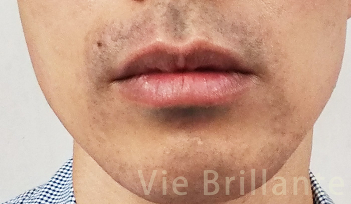 Rinx リンクス でヒゲ脱毛の評判と口コミを実際に体験した痛みも公開 解約方法も Vie Brillante